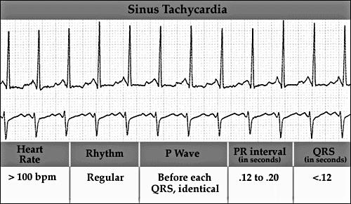 ) Tachycardia