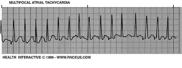 Ritmusosság, frekvencia Ha a P hullám normális és gyors sinustachycardiáról beszélünk.