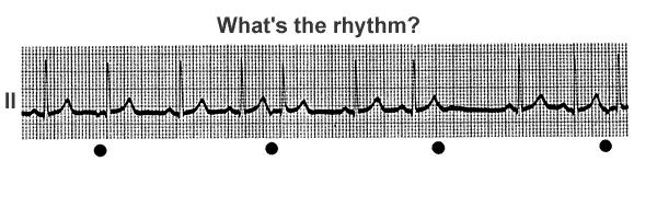 Ritmusosság, frekvencia Ectópiás pitvari góc fokozott működése során elnyomja a normál sinusműködést, de előfordulhat, hogy a kóros (70 alatti frekvenciával) és