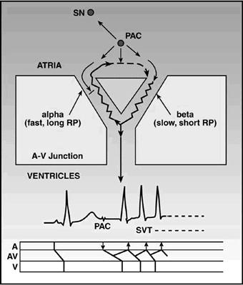 AV nodalis reentry tachycardia A frekvencia gyakran 130-250/min 1 P hullámra 1 QRS jut (a P a