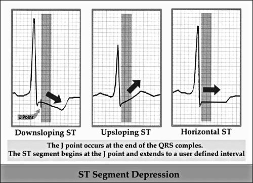 ST szakasz Secunder ST-T eltérések Bizonyos ritmuszavarok következményei és nem primer eltérés (pl.