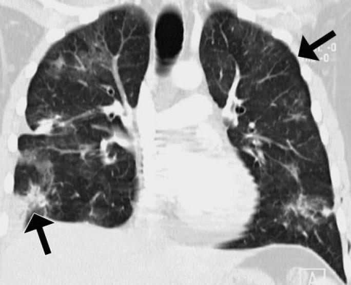 aero-bronchogram Peribroncho-vascularis distributio, lehet ék