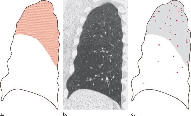 RB-ILD Respiratory Bronchiolitis Interstitial Lung Disease Dohányzással