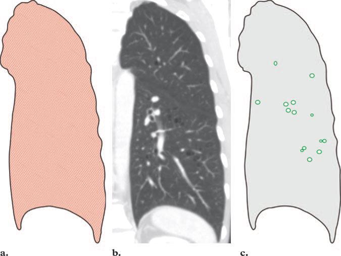 LIP Lymphoid Interstitialis Pneumonia Gyakrabban szekunder (Sjögren, HIV ) Diffúz GGO +