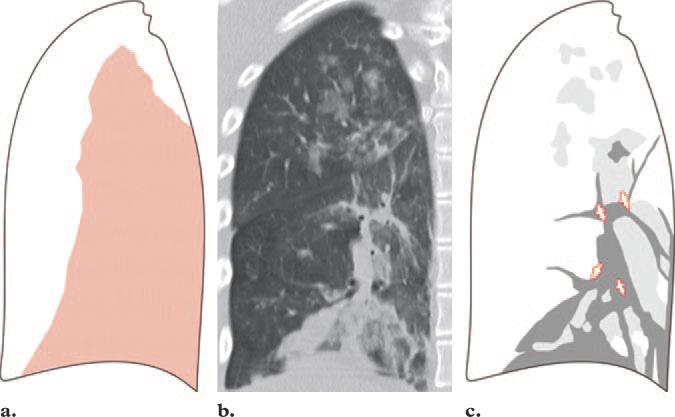 AIP Acute Interstitialis Pneumonia Acut klinikai kép, vírus