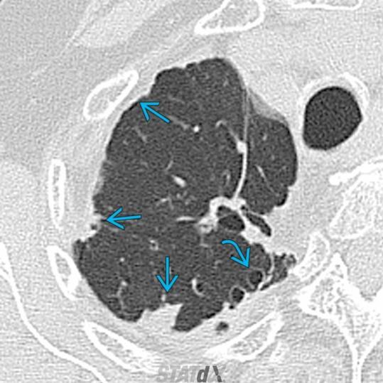 PPFE Pleuro-pulmonalis fibroelastosis