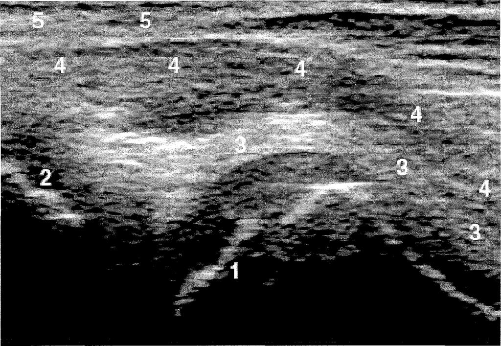 tok, 4-m. sartorius és m. rectus femoris, 5-a. femoralis) 23.