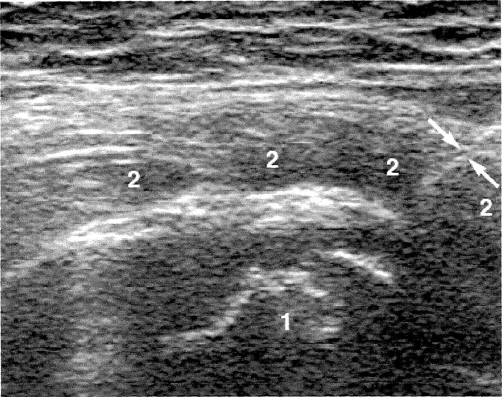 IV.4.3. A musculus iliopsoas műtét utáni helyzete A műtétet követően a leválasztott ínvég a trochanter minor tapadási helyétől 2-5 (átlagosan 3,4) cm-rel proximálisabban helyezkedik el.