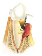 Regression analysis leading to critical probing depth as a basis for the decision making process in periodontal therapy (from Lindhe et al. (58)).