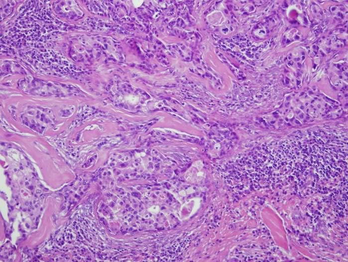 Apocrin carcinoma Egyértelmű