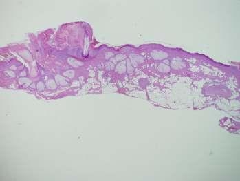 Sebaceus hyperplasia Arc, areola,