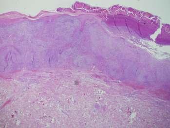 Sebaceus carcinoma Középkorú vagy idős betegek