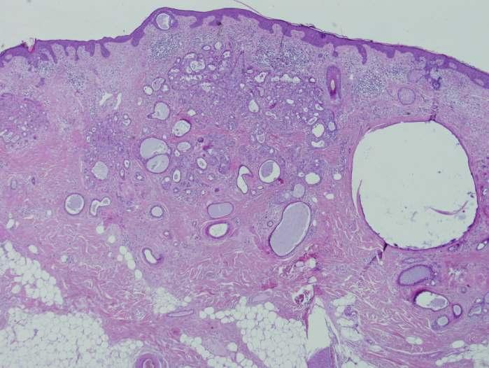 Apocrin carcinoma Esetenként