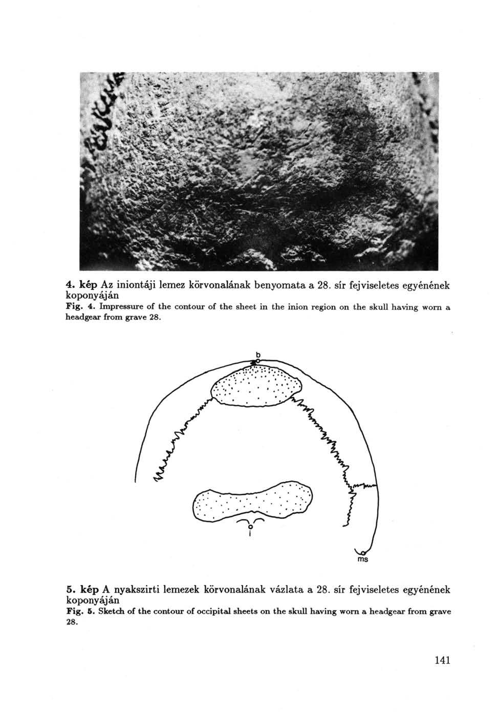 4. kép Az iniontáji lemez körvonalának benyomata a 28. sír fejviseletes egyénének koponyáján Fig. 4.
