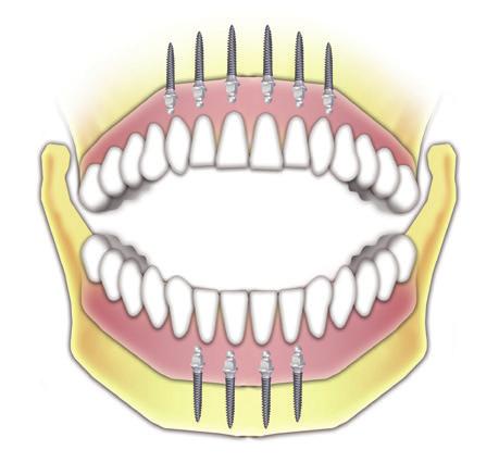 A CONEFIT lim Implantátum Rendszer A CONEFIT lim Implantátum Rendszer jellegzetes tulajdonságai miatt, az egyik