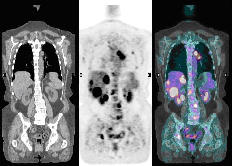 PET/CT modalitás Rekonstrukció lényegében a PET, illetve a CT