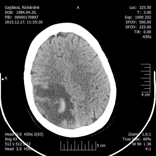 Sinus thrombosis 32 éves nő Post-partum 7.