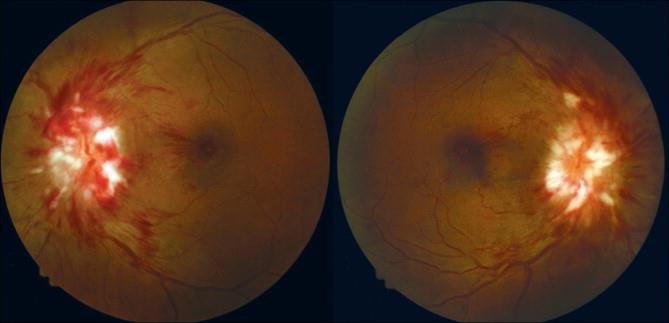 Idiopathiás intracranialis hypertensiohoz társuló fejfájás Alarmírozó jelek: Progresszív fejfájás Progresszív típusú fejfájás, diffúz, nem lüktető, köhögésre, megerőltetésre fokozódó Fogamzóképes