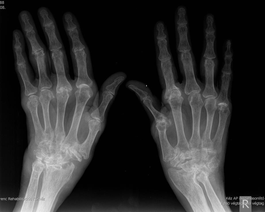6. Esettanulmány Rheumatoid arthritis Sz. K. J. Dr. Női beteg 2001-ben kezdődött a rheumatoid arthritise a kezek és a lábak duzzanataival és fájdalmaival.