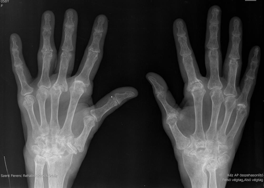 2016.06.22. A készített összehasonlító kéz felvételen, mindkét oldalon a kéztőcsontok lelapultak, deformált inhomogén szerkezetűek, a csuklóízületek beszűkültek és deformáltak. Jobb oldalon az I., II.