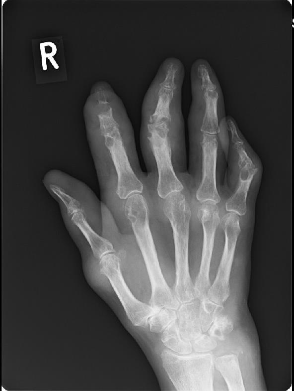 4. kép Bal kéz 2 irányú röntgenfelvétel