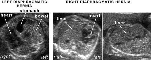 DIAPHRAGMATIC HERNIA Herniation of the abdominal viscera into the thorax at about 10 12 weeks, when the intestines return to the abdominal