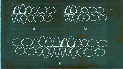 Kiegyenlítő extractio az antagonista fogsorban Orthodontiai