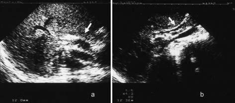 18 6 645 Figure1. 腹部超音波検査 a: 上部総胆管の拡張 ( 胆管径 12mm) を認めた ( 矢印 ).