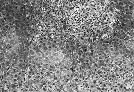 肝生検組織像 (HE 染色 200): 門脈域の細胆管は軽度増生しリンパ球, 組織球を中心とする炎症細胞の浸潤を認めた. 肝細胞の破壊は軽度で類洞内にリンパ球の浸潤を認めた. PSC IgG4 20.
