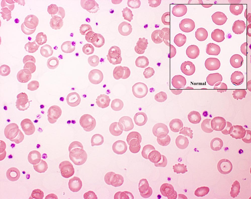 Idiopathiás haemochromatosis nyálkahártyablokk zavart