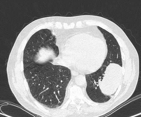 Esetismertetés VI. A nivolumab kezelés újraindult. A kezelés 12. és 24.