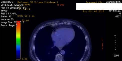 PET/CT a kezelés után fél