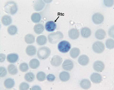 Reticulocyta Emelkedett: hemolitikus anemiák, vérvesztés, regeneráció Csökkent: csontvelő betegségek, erythropoetin hiány,