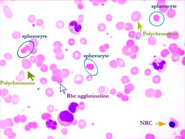 Meleg antitest okozta AIHA IgG és/vagy komplement mediált folyamat a vérben spherocytosis v.