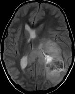 parietalis inhomogén tumor