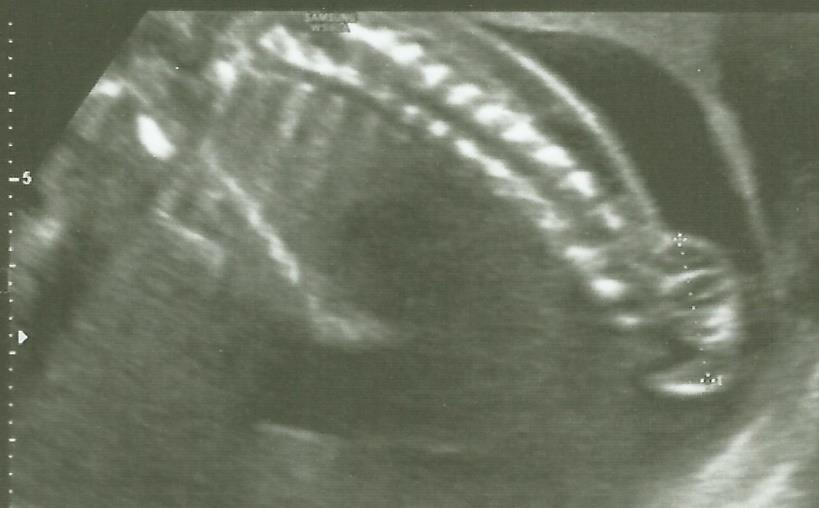 1. ábra Spina bifida cystica 2. ábra Deformált koponya, "citrom" jel Prenatalis vizsgálatokkal körülbelül a velőcsőzáródási rendellenességek 88%-a detektálható (25-94%) [Boyd és mtsai 2008].