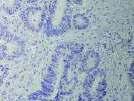 HER2 Positivity in Gastric Cancer: IHC Score 0 1+ 2+ 3+ Surgical Specimen Staining Pattern No reactivity or membranous reactivity in < 10% of tumor cells Faint or barely perceptible membranous
