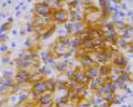 basolateral or lateral membranous reactivity in 10% of tumor cells Bang Y, et al. Lancet. 2010;376:687-689.