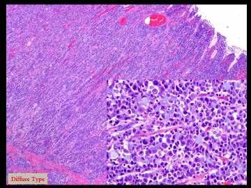 Gastric Cancer Subtypes Intestinal Glandular appearance, spreads through the wall as part of a tumor mass Epidemic type : more common to high-risk areas (eg, China, Japan) Thought to be responsible