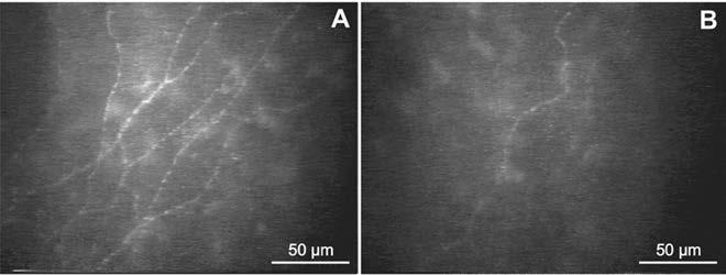 In vivo konfokális cornea mikroszkópia a diabéteszes neuropathia diagnosztikájában szisztémás betegségeknek a szaruhártyában is jelentkező patológiás folyamatainak noninvazív vizsgálatában,