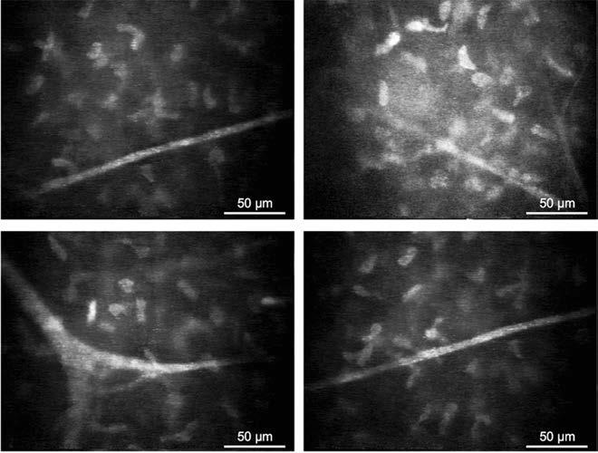 In vivo corneal confocal microscopy for assessment of diabetic neuropathy idegrostok száma is látszólag kevesebb.