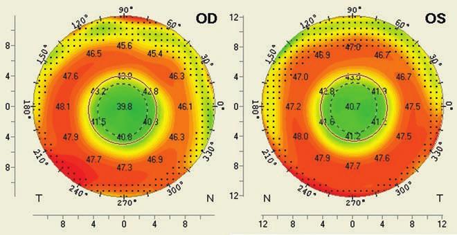 Myopia 14 éves kezeléskor - Árnyékdiagram a látáshoz