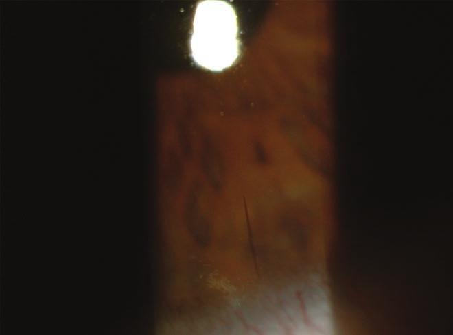 Intraocular penetration of caterpillar hair reakciót, valamint szemészeti betegségeket.