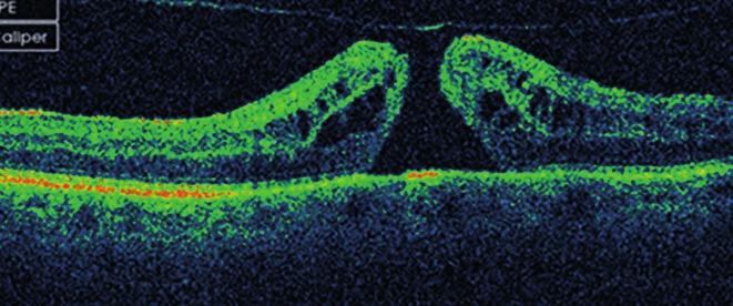 Spontaneous closed macular hole in a pseudophakic eye, a case report 2. ábra: oct-kép, 1 hónap múlva, bcva: 0,04 3.