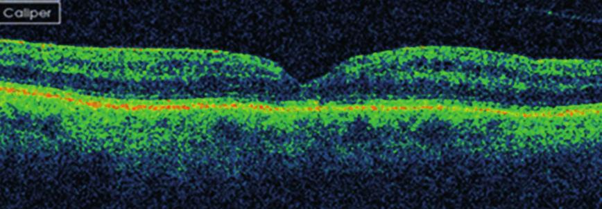 Spontaneous resolution of small stage 3 and 4 fullthickness macular holes viewed by optical coherence tomography. Retina 2001; 21: 186 189. 2. Menchini U, Virgili G, Giacomelli G, et al.