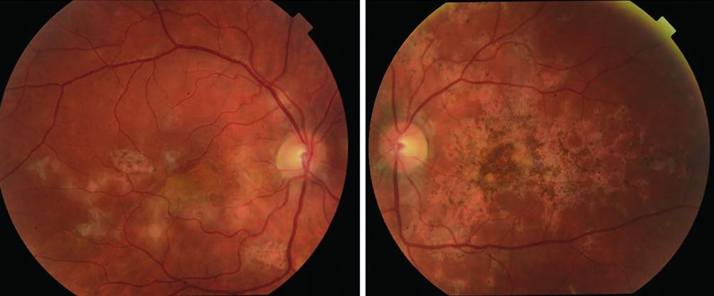 acute posterior multifocal