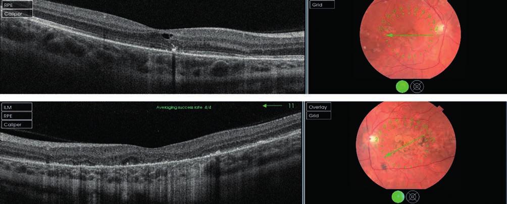 acute posterior multifocal placoid pigment epitheliopathy 7.