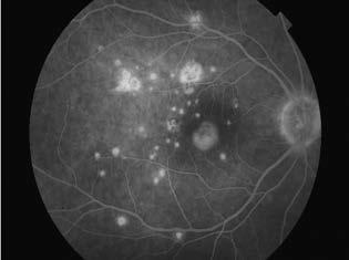 Nodularis léziók láthatóak a retinális pigmentepithelium alatt, amelyek szolid pigmentepithel-leválást okoznak.