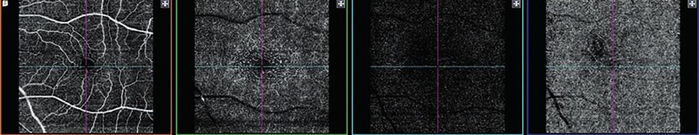 optikai koherencia tomográfia angiográfia jelentősége 5.