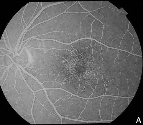 neovaszkuláris membrán figyelhető meg 6. ábra: a bal szemről készült octa-felvételen jól láthatók a fovea körül kialakult mikrovaszkuláris abnormalitások, kóros érújdonképződés nem látható 7.